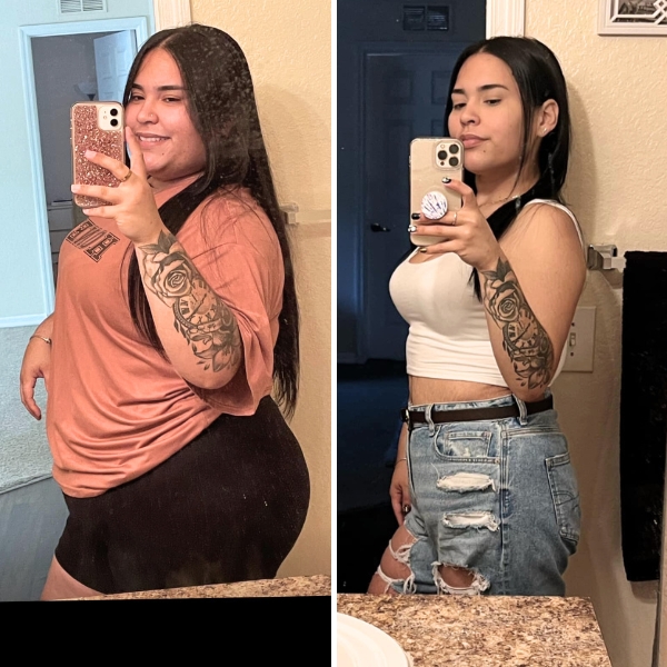 Mileyshka - Before and after Gastric sleeve Surgery Patient with Dr. Jacqueline Osuna
