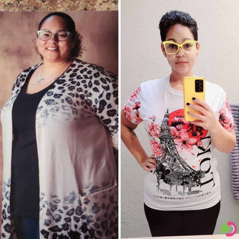 Danielle R Before and After Gastric Sleeve